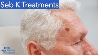 Seborrheic Keratosis Treatment & Removal: Liquid Nitrogen & Curetagge