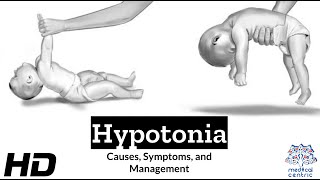 Hypotonia Explained: What You Need to Know