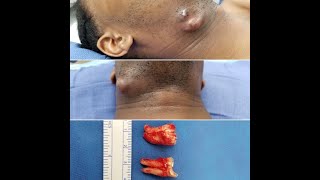 Submandibular Odontogenic Abscess (Tooth Pus!)