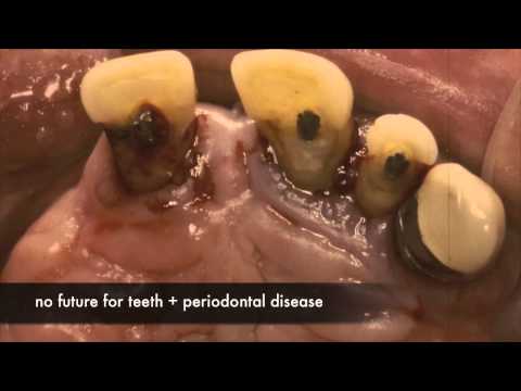 Overdenture fitted on double crowns