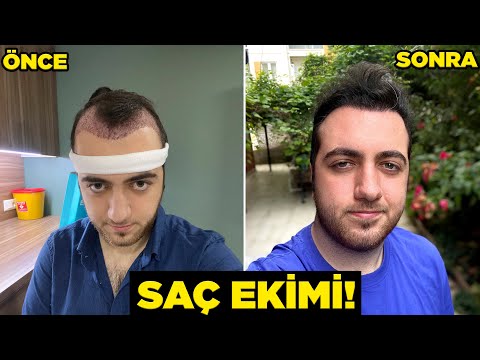 Saç Ekiminde Dikkat Edilmesi Gerekenler Resim