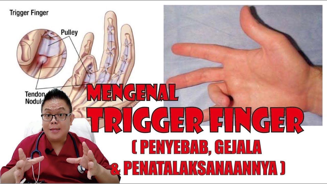 TRIGGER FINGER............. CAUSES, SYMPTOMS AND TREATMENT