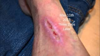 Progressive wound healing