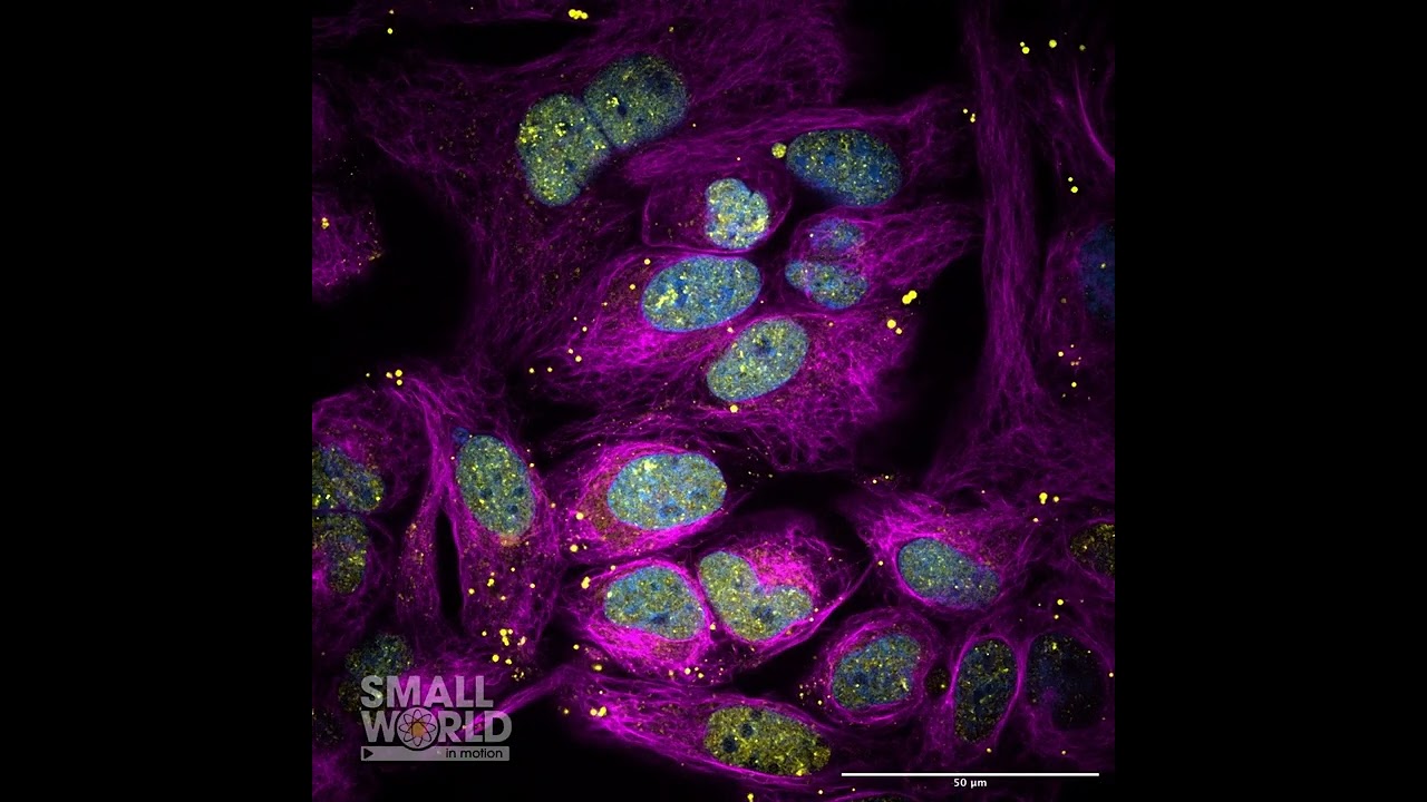Biomolecular condensates forming in cancer cells