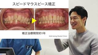 マウスピース矯正 動画