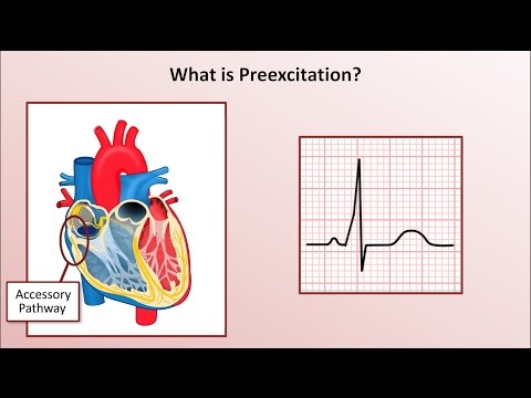 Advanced EKGs - Wolff-Parkinson-White (WPW) Syndrome