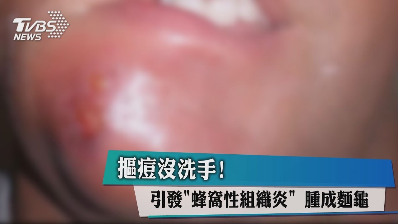 摳痘沒洗手！　引發「蜂窩性組織炎」腫成麵龜