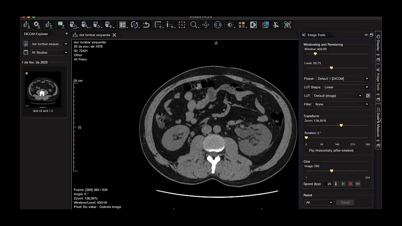 URETEROLITÍASE A ESQUERDA