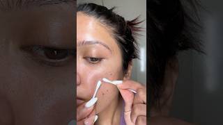 Let’s peel this mega pimple patch and do some extraction #acne #pimplepatch #acnepatch #acneprone