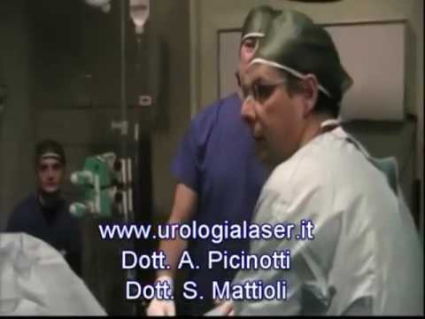 Membro premuto sulla prostata Dopo la rimozione degli effetti prostata