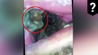 Maggots in mouth: Man’s mouth contains horrific, black, wriggling mass - TomoNews