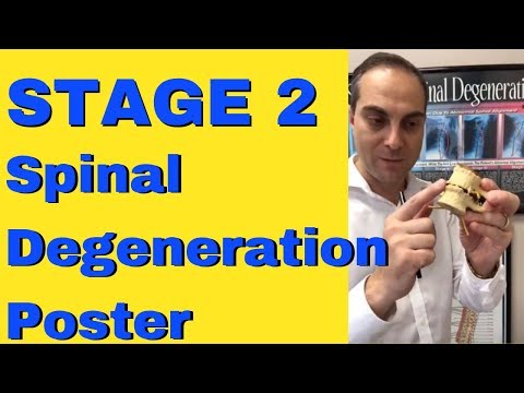 Teil 3 von 5 – Stadium 2 – Stadien der Wirbelsäulendegeneration – Poster – von Chiropraktiker in ...