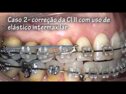 Tempo de duração do tratamento Ortodôntico