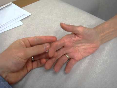 Digital Neuroma and Pain Cured