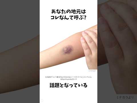 知ってた？全国でこんなに違う&ldquo;青あざ&rdquo;の呼び方 #方言 #青あざ