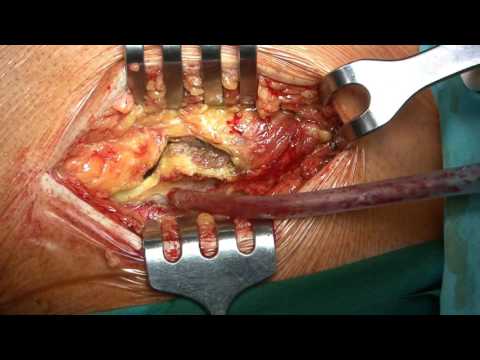 Cuscino con una sporgenza della colonna vertebrale cervicale Collo mal di gola e le cause del collo