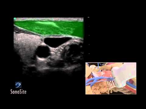 How To: Ultrasound Guided Insertion Internal Jugular Catheter (Trans) - Sonosite Ultrasound 3D Video