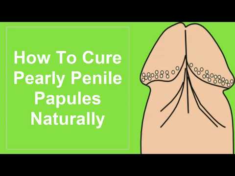 papilloma urotheliale mpv yuksekligi nedir
