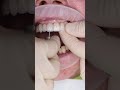 Dental Implant S All On 4 In Prague Shorts Dentist Dental Implant Veneers Short