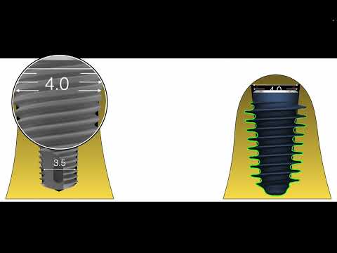 SUBCRESTAL VS CRESTAL IMPLANT PLACEMENT