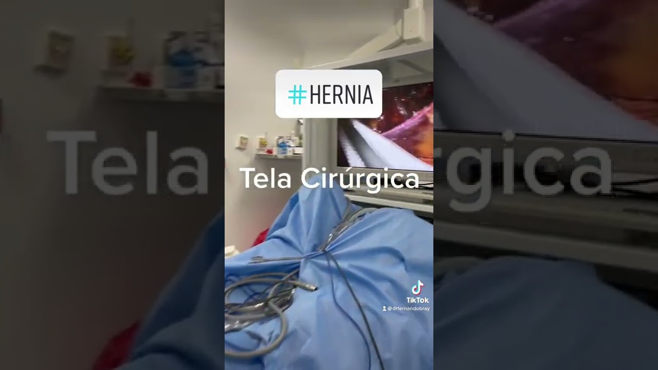 Watch Now Tela cirúrgica usada em cirurgias de #hernia. Tela cirúrgica usada em cirurgias de #hernia.