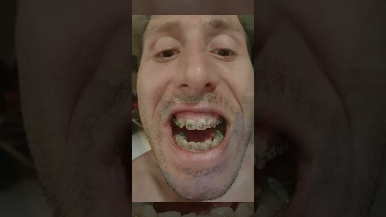 Apparecchio ai denti tutte le foto prima e dopo