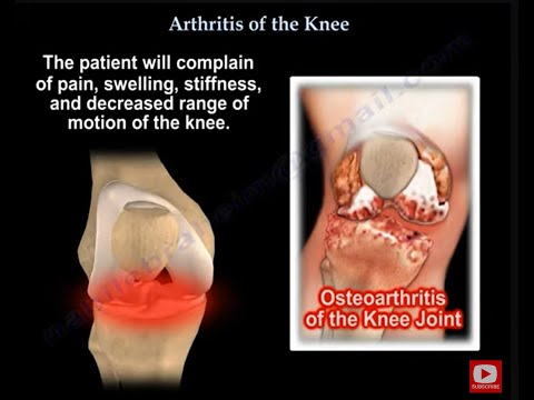 Kniearthritis und die damit verbundenen Schmerzen verstehen