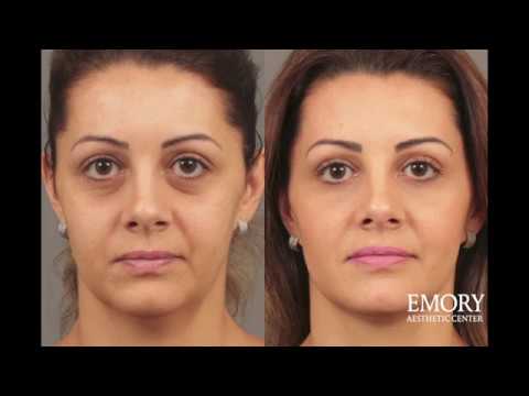 download lagu mp3 mp4 About Fillers, download lagu About Fillers gratis, unduh video klip About Fillers