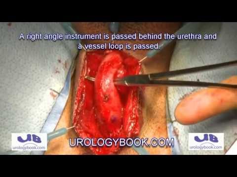 Tylna uretroplastyka zwężenia cewki moczowej męskiej 