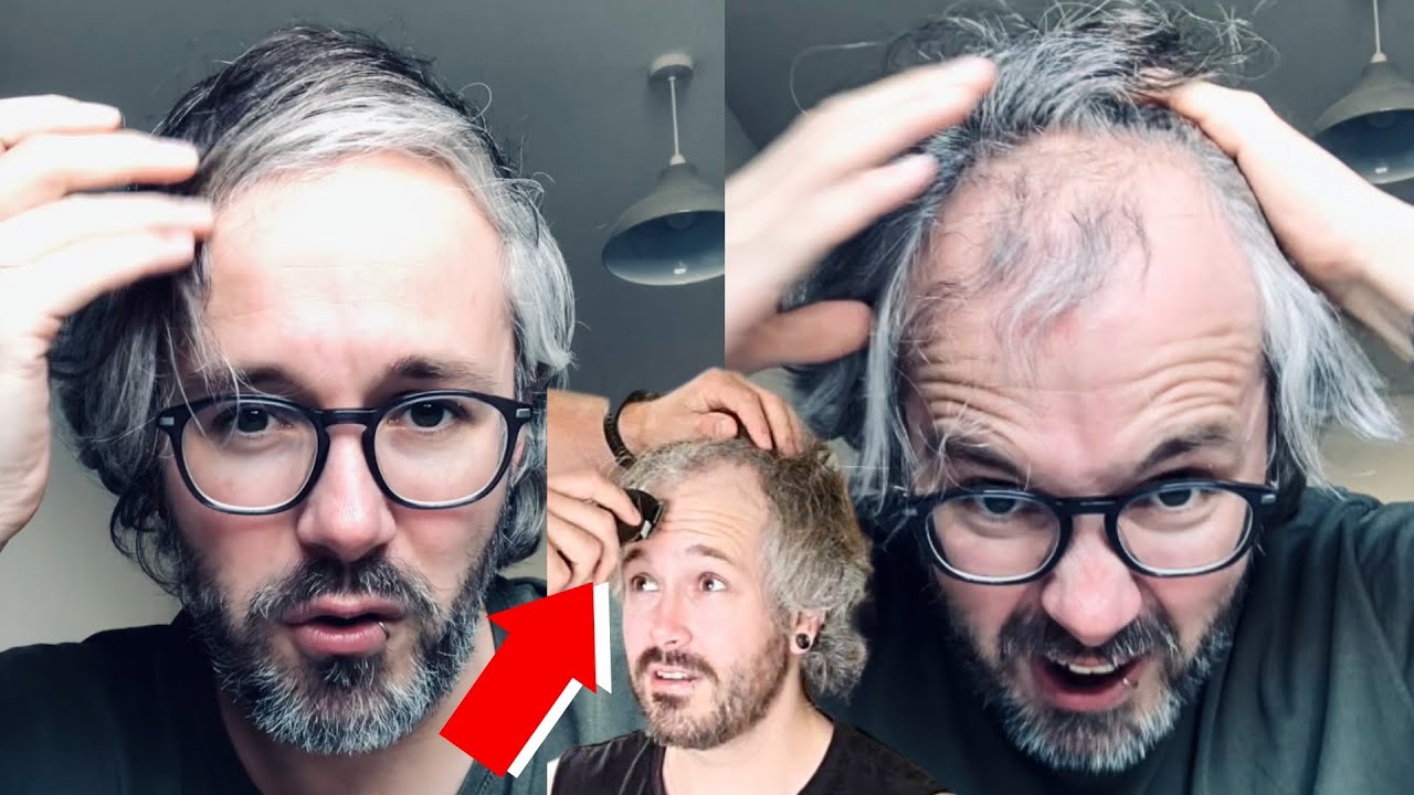 BALDING Man Has A *LIFE CHANGING TRANSFORMATION*