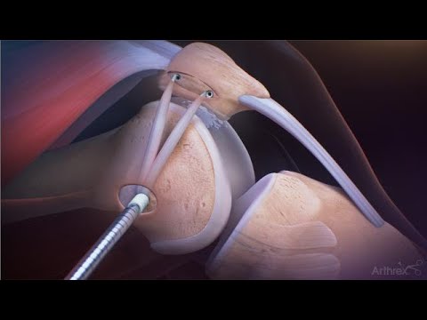 MPFL-Rekonstruktion mit 3,9 mm BioComposite SwiveLock®-Implantat-Kits