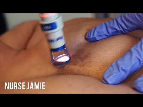 Remove Stubborn Sun Spots or Scaring with Nurse Jamie
