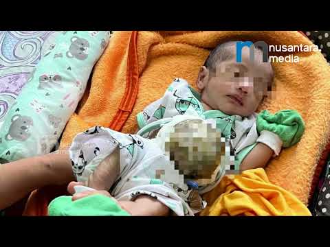 Bayi 2 Bulan Asal Pandeglang Berjuang Nyawa, Usus Keluar dari Perut