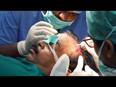 Advanced Hair Transplant surgery