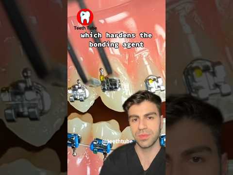 Putting Braces On - Step By Step