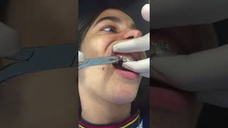 traccion de caninos retenidos