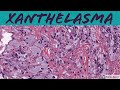 Xanthelasma (Xanthoma of Eyelid): 5-Minute Pathology Pearls