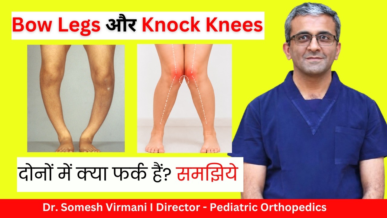 बच्चे के पैर टेढ़े हैं? | Bow legs या Knock Knees! कैसे पहचानें? | समझिये | Dr. Somesh Virmani