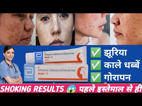 Melalite 15 cream review | whiten face | melalite cream | Melalite Cream