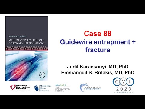 Case 88: PCI Manual - Wire entrapment and fracture