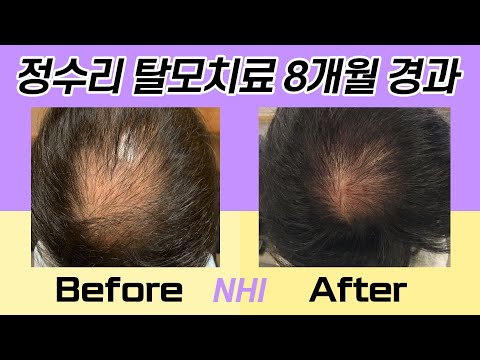 정수리탈모치료 정수리모발개선 240일 경과 I 뉴헤어 I 모발이식 I 탈모치료 I Before&After