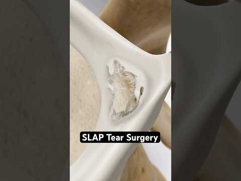 SLAP-Läsionsoperation (3D-Animation)