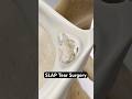 SLAP Tear Surgery (3D animation)