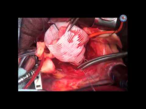 [Keynote Lecture] Aortic valve sparing operations: outcomes at 20 years