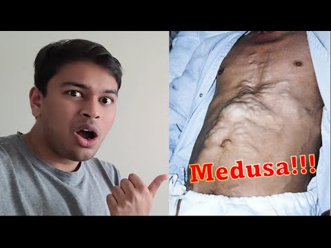 SNAKES in his STOMACH?! | Explaining Caput Medusae and Abdominal Venous System | Doctor Squared