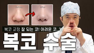 복코수술, 같은 수술인데 왜 결과는 다를까? 복코, 다 똑같지 않아요! 수술 전 꼭 체크해야 할 3가지 조건!