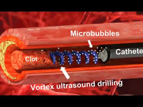 New tool uses ultrasound 'tornado' to break down blood clots