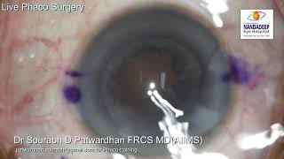 Acriol EC toric live streamed