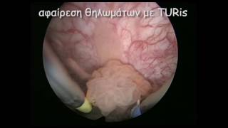 Αφαίρεση θηλωμάτων με TURis