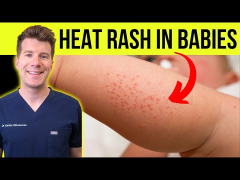 Doctor explains HEAT RASH (miliaria) in a baby | Causes, symptoms, treatment and prevention